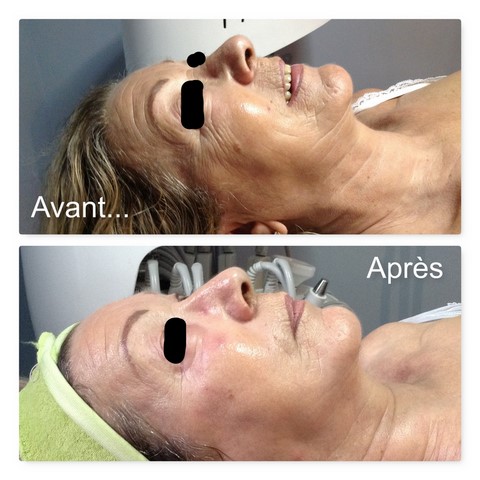 soin visage radio-fréquence anti-âge